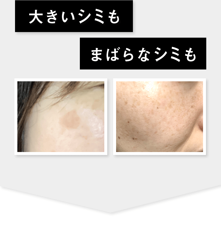 大きいシミも まばらなシミも
