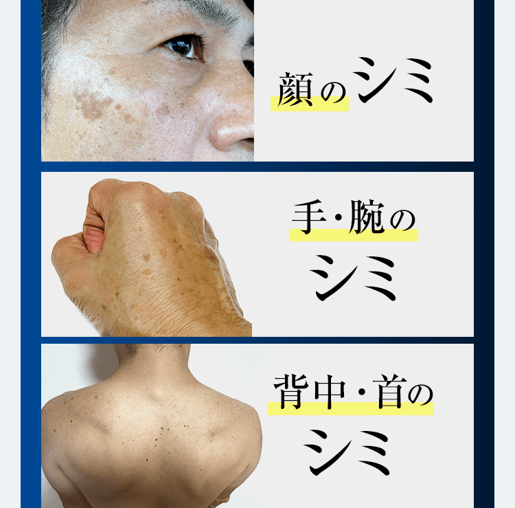 顔のシミ、手・腕の シミ、背中・首の シミ