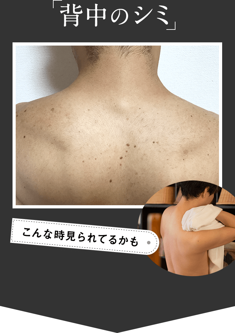 背中のシミ こんなとき見られてるかも