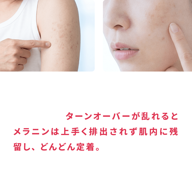 通常シミの元であるメラニンは、ターンオーバーによって肌の外へ排出されます。しかし、ターンオーバーが乱れるとメラニンは上手く排出されず肌内に残留し、どんどん定着。いつまでもシミが居座り続けてしまうのです。