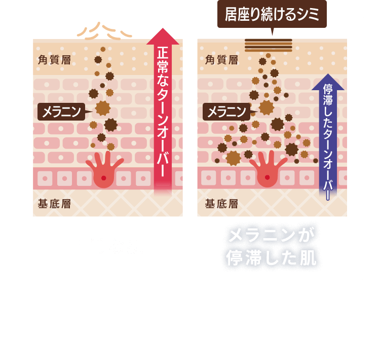 正常な肌 メラニンが 停滞した肌