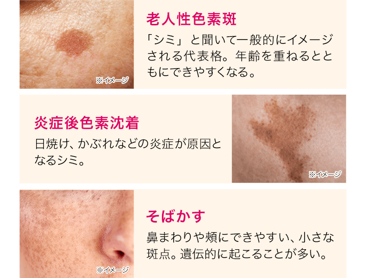 老人性色素斑「シミ」と聞いて一般的にイメージされる代表格。年齢を重ねるとともにできやすくなる。※イメージ 炎症後色素沈着日焼け、かぶれなどの炎症が原因となるシミ。※イメージ そばかす鼻まわりや頰にできやすい、小さな斑点。遺伝的に起こることが多い。※イメージ