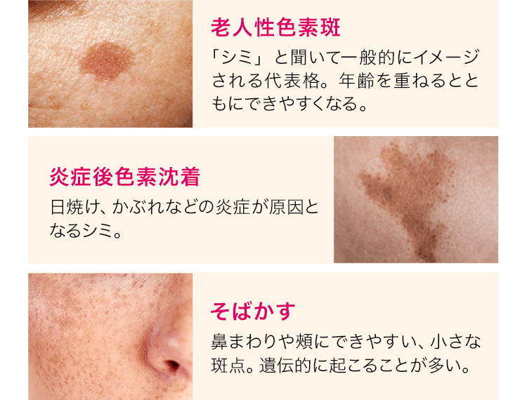 老人性色素斑「シミ」と聞いて一般的にイメージされる代表格。年齢を重ねるとともにできやすくなる。炎症後色素沈着日焼け、かぶれなどの炎症が原因となるシミ。そばかす鼻まわりや頰にできやすい、小さな斑点。遺伝的に起こることが多い。