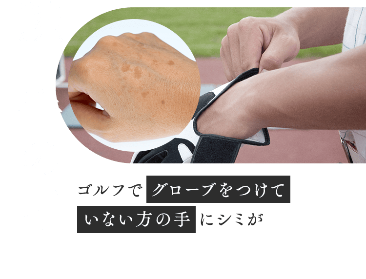 【腕・手の甲】ゴルフで グローブをつけていない方の手にシミが