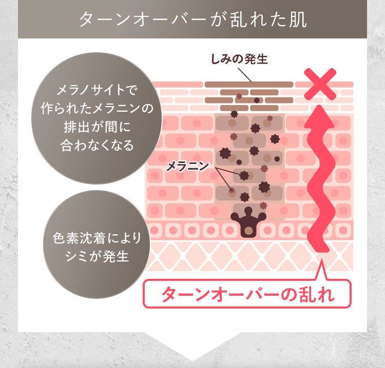 ターンオーバーが乱れた肌 メラノサイトで作られたメラニンの排出が間に合わなくなる 色素沈着によりシミが発生